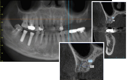 インプラント治療の診査・診断