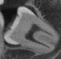 コーンビームCT